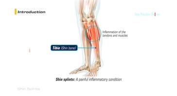 Picture of Shin Splints
