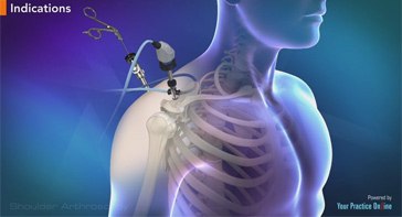Picture of Shoulder Arthroscopy