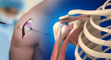 Picture of Shoulder Impingement