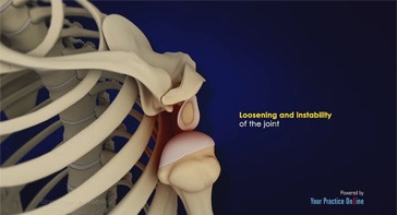 Picture of Shoulder Instability
