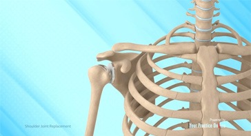Picture of Shoulder Joint Replacement