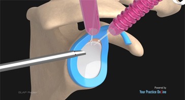 Picture of SLAP Repair