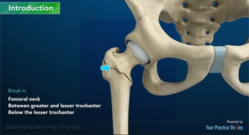 Picture of Subtrochanteric Hip Fracture