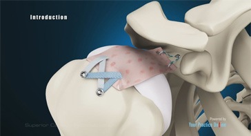 Picture of Superior Capsule Reconstruction