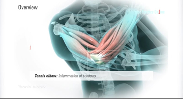 Picture of Tennis Elbow