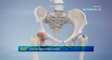 Picture of Total Hip Replacement