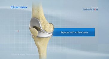 Picture of Total Knee Replacement