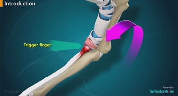 Picture of Trigger Finger