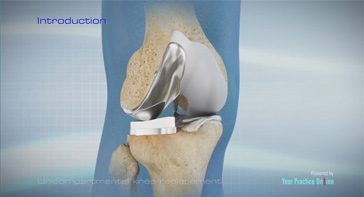 Picture of Uni Knee Replacement