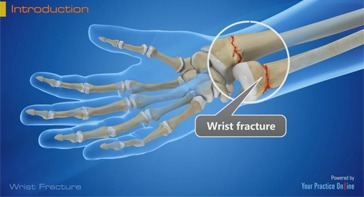 Picture of Wrist Fracture