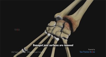 Picture of Wrist Joint Replacement