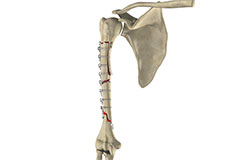 complex-fracture-repair-of-the-shoulder