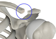 distal-clavicle-excision