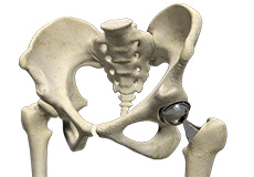 outpatient-hip-replacement
