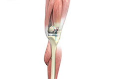 outpatient-knee-joint-replacement