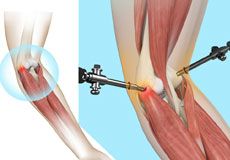 tennis-elbow-surgery