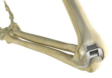 total-elbow-replacement