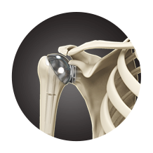 Total Shoulder Arthroplasty