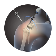 Arthroscopic Procedures