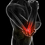  Distal Biceps Avulsion 