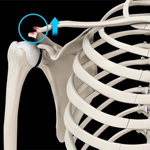 AC Joint Dislocation/Acromioclavicular Joint Dislocation