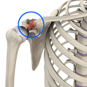 Acromioclavicular (AC) Joint Osteoarthritis
