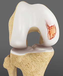 Articular Cartilage Injury