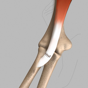 Biceps Tendon Repair