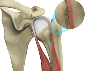 Bicep Tendon Rupture