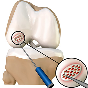 Cartilage Microfracture