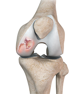 Chondral or Articular Cartilage Defects