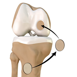 Chondroplasty