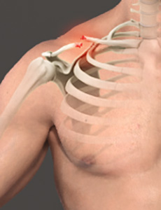 Clavicle Fracture