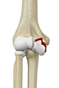 Distal Humerus Fractures of the Elbow