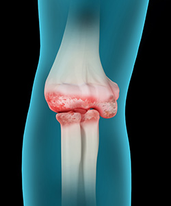 Elbow Arthritis