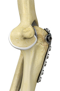 Elbow Fracture Reconstruction