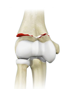 Elbow Fractures