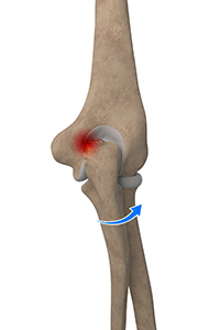Elbow Impingement