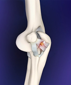 Elbow Ligament Reconstruction