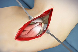 Elbow Surgery