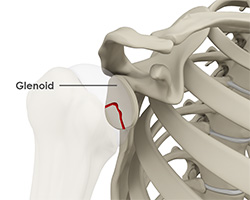 Glenoid Fractures