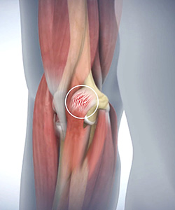 Golfer's Elbow