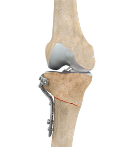 High Tibial Osteotomy