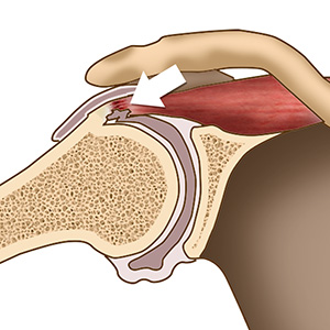 Internal Impingement of the Shoulder