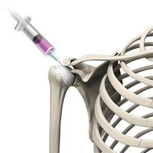 Intraarticular Shoulder Injection