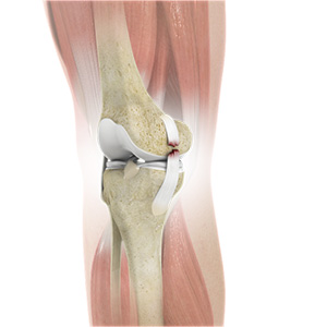 Knee Ligament Injuries
