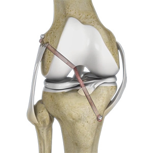 Knee Ligament Reconstruction
