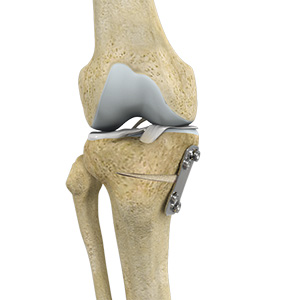Knee Osteotomy Columbia | High Tibial Osteotomy Columbia | Knee