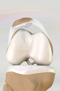 Lateral Patellar Compression Syndrome