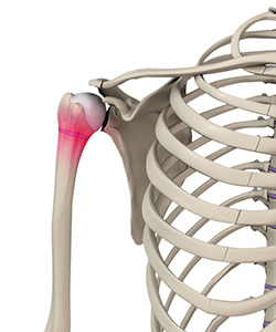 Little League Shoulder